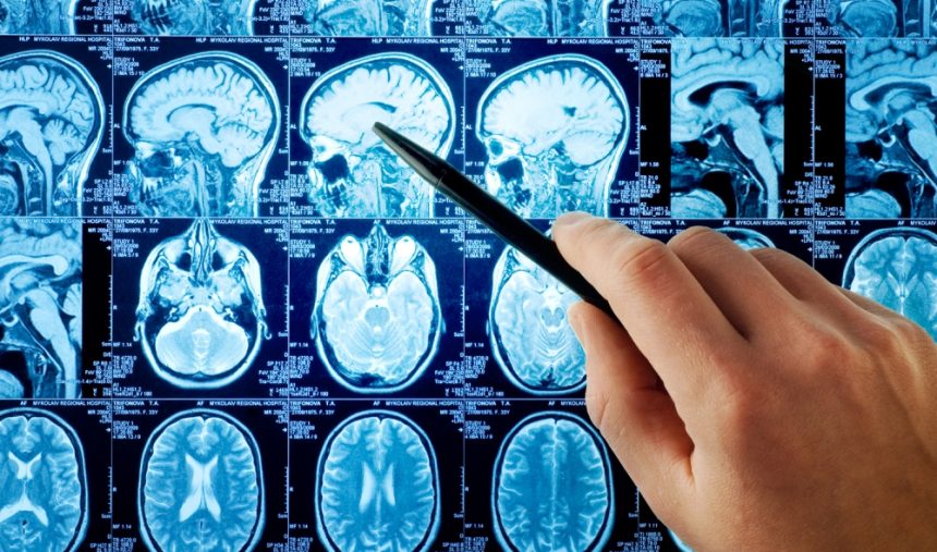 Important Information about Brain Tumor