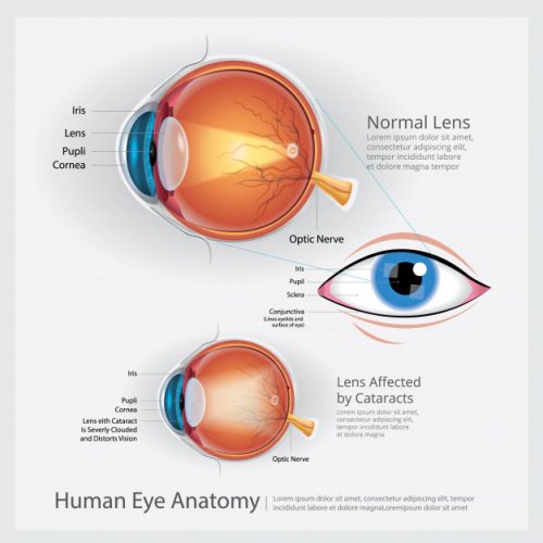 Everything About Cataract Surgery from Anaya Clinic – Best hospital for cataract surgery in Indore