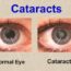 Cataract Treatment and Surgery In Indore