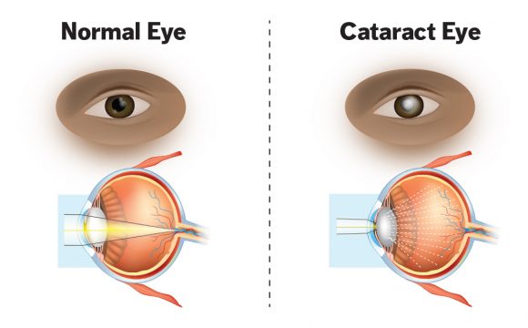 Cataract Surgery in Indore