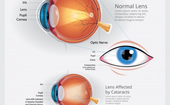Everything About Cataract Surgery from Anaya Clinic – Best hospital for cataract surgery in Indore