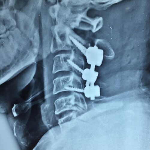 cervical spine treatment in Indore